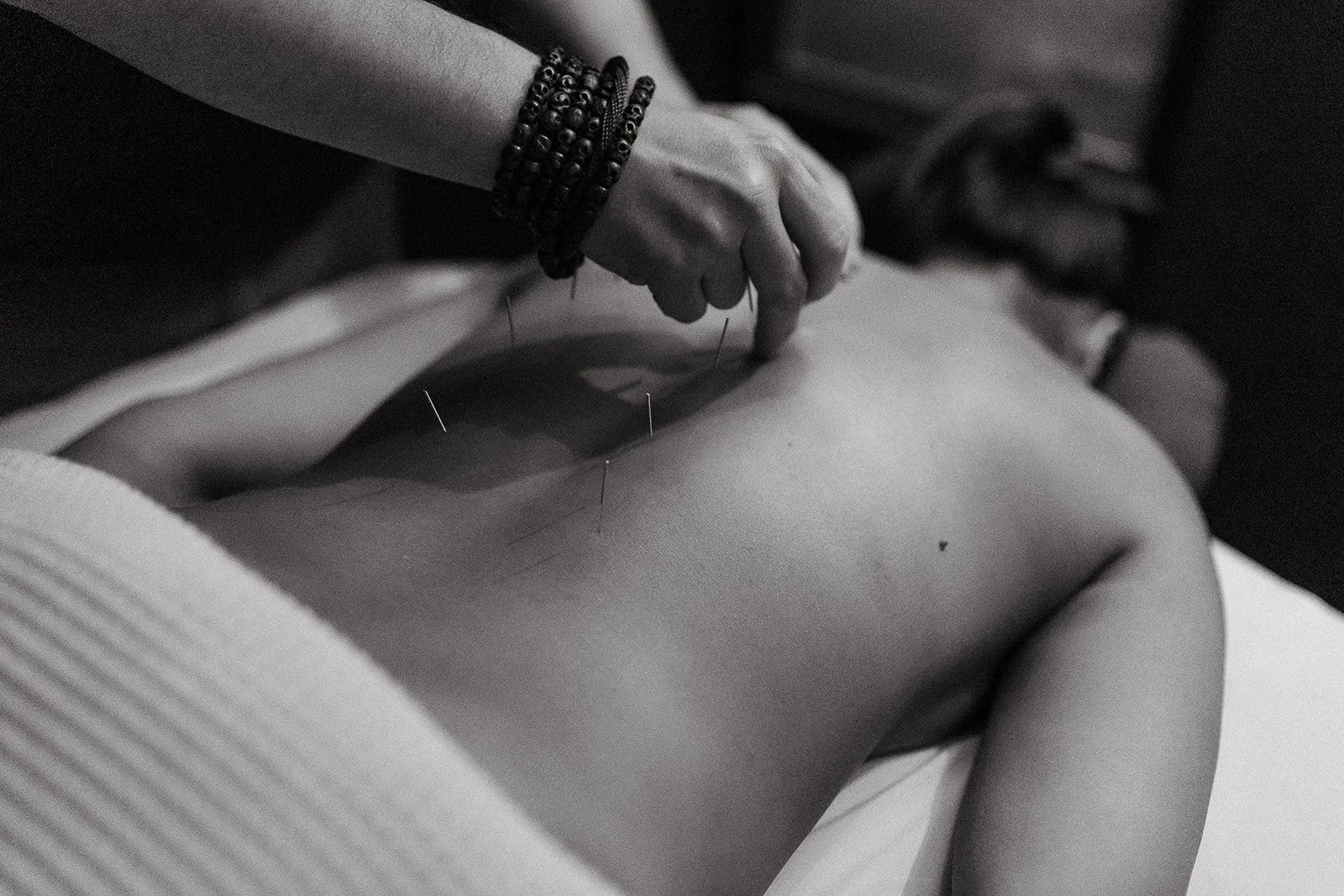 Acupuncture service